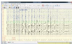 Image result for Bifrontal Spikes EEG