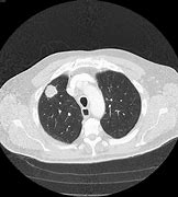 Image result for CT Scan Showing Lung Cancer