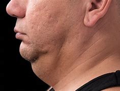 Image result for CoolSculpting Jowls