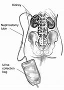 Image result for Nephrostomy Bag Urine