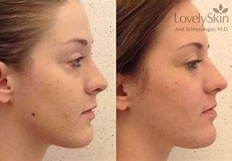 Image result for Mole Removal Before and After