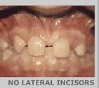 Image result for Upper Right Lateral Incisor