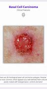 Image result for Basal Cell Scalp Lesion