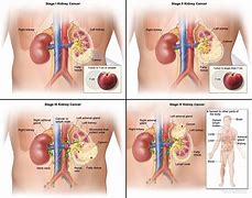 Image result for Renal Cell Carcinoma Staging
