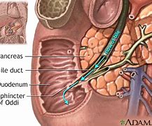 Image result for Biliary Tract Obstruction