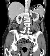 Image result for Large Renal Cyst