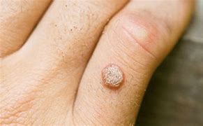 Image result for Wart Mole