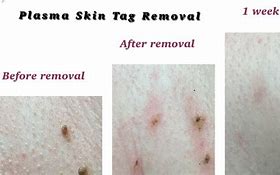 Image result for Plasma Pen Mole Removal