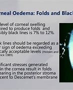 Image result for Episcleritis and Contact Lens Wear