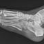 Image result for Jones Fracture Radiology