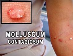 Image result for Molluscum Treatment Adults