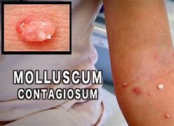 Image result for Molluscum Contagiosum Eczema