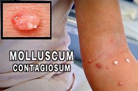 Image result for Molluscum Contagiosum Tattoo