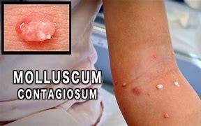 Image result for Molluscum Contagiosum Healing Stages