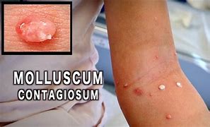 Image result for Molluscum Treatment Adults