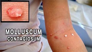 Image result for Popping Molluscum