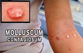 Image result for Molluscum Contagiosum Liquid Nitrogen Treatment