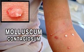 Image result for Molluscum Contagiosum Removal