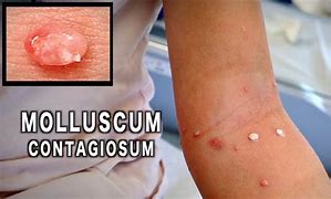 Image result for Molluscum Contagiosum Liquid Nitrogen Treatment