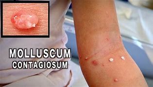 Image result for Treatment for Molluscum Contagiosum
