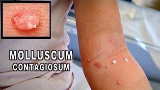 Image result for Molluscum After Treatment