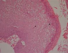 Image result for Squamous Papilloma Ear Canal