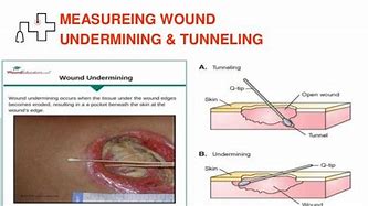 Image result for Limited Undermining Wound