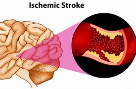 Image result for Ischemic Stroke