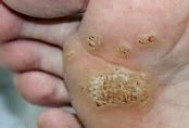 Image result for Wart Treatment with Salicylic Acid