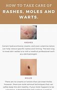 Image result for Wart Treatment Reactions