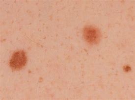 Image result for Stage 1 Melanoma