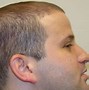 Image result for Bald Hair Transplant