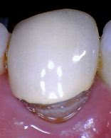Image result for Rotten Tooth Under Crown