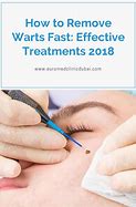 Image result for Viral Warts Treatment