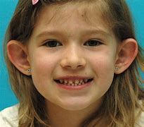 Image result for Protruding Ears Girl