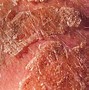 Image result for Pics of Eczema On Scalp
