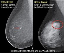 Image result for BREAST