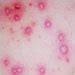 Image result for Chickenpox Dermnet