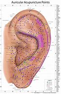 Image result for Auricular Acupuncture