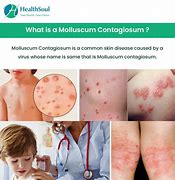 Image result for Mollusc Contagious