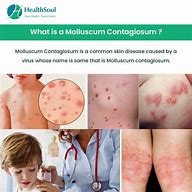 Image result for Molluscum Contagiosum Virus Infection Epidemiology