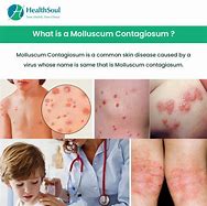 Image result for Molluscum Contagiosum Symptoms in Children