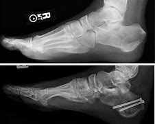 Image result for Calcaneus Fracture