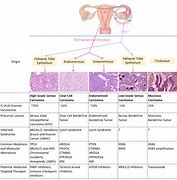 Image result for Epithelial Ovarian Cancer Types