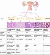 Image result for Ovarian Cancer Grades