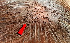 Image result for World Biggest Head Lice