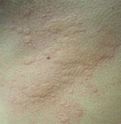 Image result for Skin Rash Hives Causes