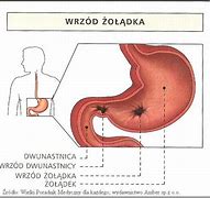 Image result for choroba_wrzodowa