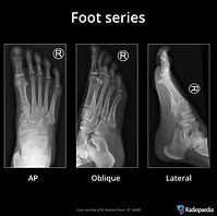 Image result for X-ray Technique Chart
