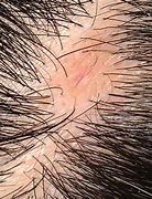 Image result for Vellus Hair Part